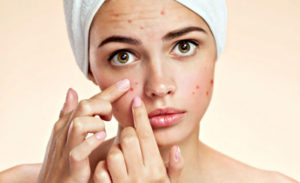 the battle against acne